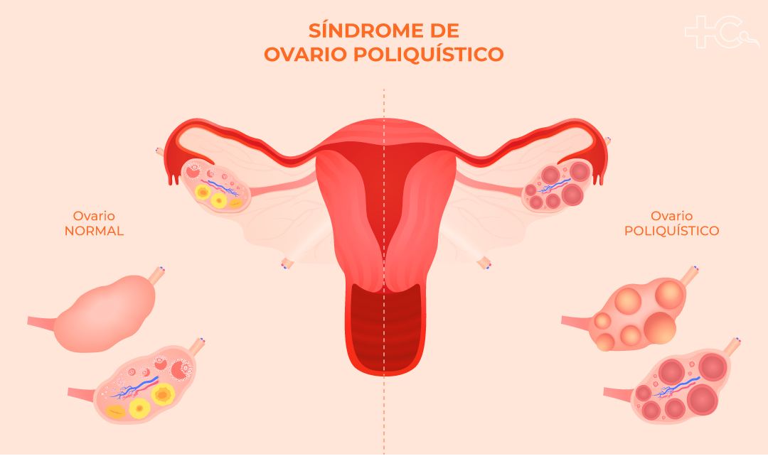 ¿Puedo donar óvulos si tengo ovarios poliquísticos?